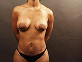Patient # 14587 After Photo # 2
