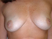 Patient # 74893 Before Photo # 1