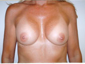 Patient # 36882 After Photo # 2
