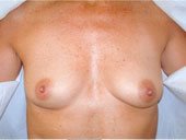 Patient # 36882 Before Photo # 1