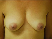 Patient # 97370 Before Photo # 1