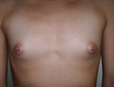 Patient # 95293 Before Photo # 1