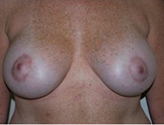 Patient # 14878 After Photo # 2