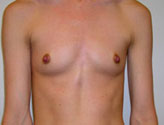 Patient # 90677 Before Photo # 1