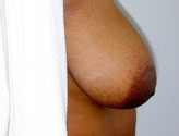 Patient # 40895 Before Photo # 5