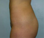 Patient # 57718 After Photo # 4