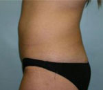 Patient # 57718 Before Photo # 3