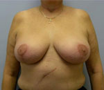 Patient # 48466 After Photo # 2