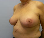 Patient # 48466 After Photo # 4