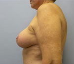 Patient # 48466 After Photo # 6