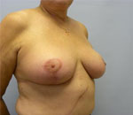 Patient # 48466 After Photo # 8