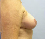 Patient # 48466 After Photo # 10