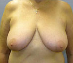 Patient # 48466 Before Photo # 1