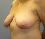 Patient # 48466 Before Photo # 3