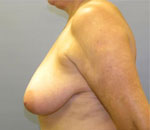 Patient # 48466 Before Photo # 5