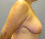 Patient # 48466 Before Photo # 9