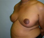 Patient # 52712 After Photo # 6