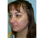 Patient # 49608 After Photo # 4