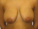 Patient # 90169 Before Photo # 1