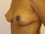 Patient # 67206 After Photo # 4