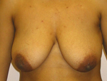 Patient # 67206 Before Photo # 1