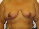 Patient # 94911 After Photo # 2