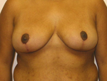 Patient # 64907 After Photo # 2