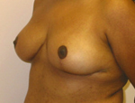 Patient # 64907 After Photo # 4