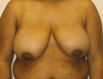 Patient # 64907 Before Photo # 1