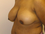 Patient # 64907 Before Photo # 3