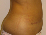 Patient # 26248 After Photo # 2