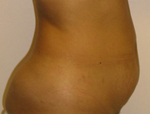 Patient # 26248 Before Photo # 1