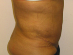 Patient # 16035 After Photo # 2