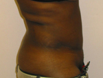 Patient # 57622 After Photo # 2