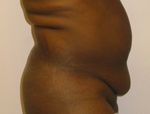 Patient # 57622 Before Photo # 1