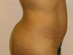 Patient # 78863 Before Photo # 3