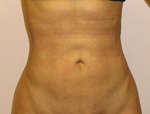 Patient # 24547 After Photo # 2