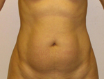 Patient # 24547 Before Photo # 1