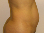 Patient # 24547 Before Photo # 3