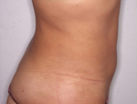 Patient # 93501 After Photo # 4