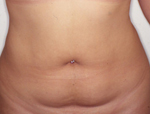 Patient # 93501 Before Photo # 1