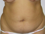 Patient # 20117 Before Photo # 1
