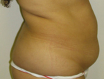 Patient # 20117 Before Photo # 3