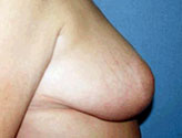 Patient # 24295 After Photo # 4