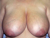 Patient # 24295 Before Photo # 1