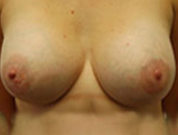 Patient # 13291 After Photo # 2