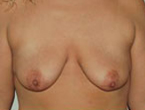 Patient # 71382 Before Photo # 1