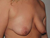 Patient # 71382 Before Photo # 3