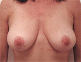 Patient # 62061 After Photo # 2