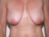 Patient # 62061 Before Photo # 1